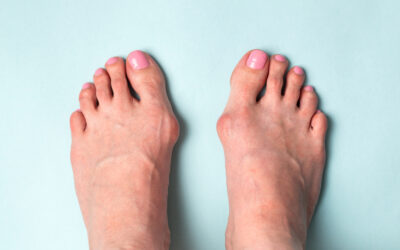 Bunions, Flat Feet & Maria’s Personal Foot Health Journey